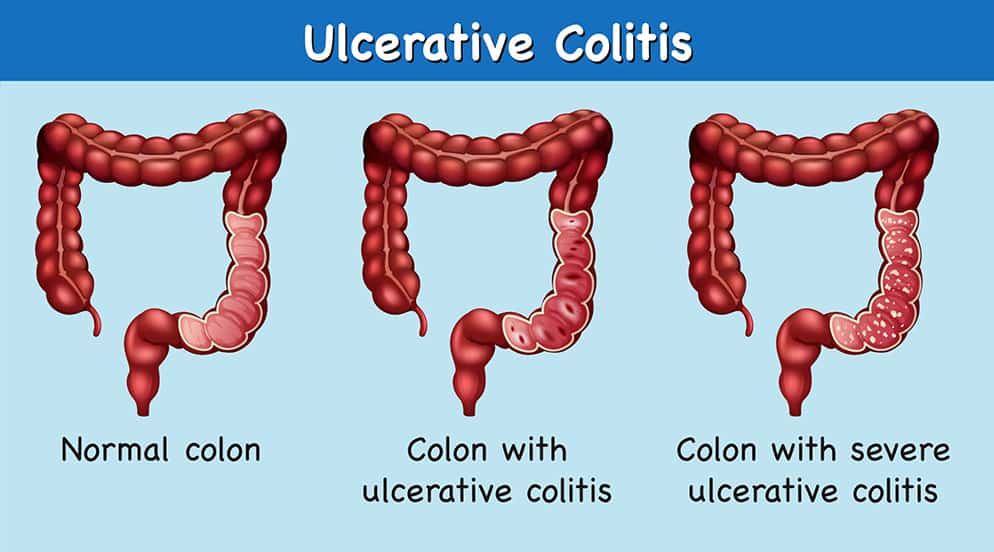 An illustration of human gut anatomy showing the effects of ulcerative colitis